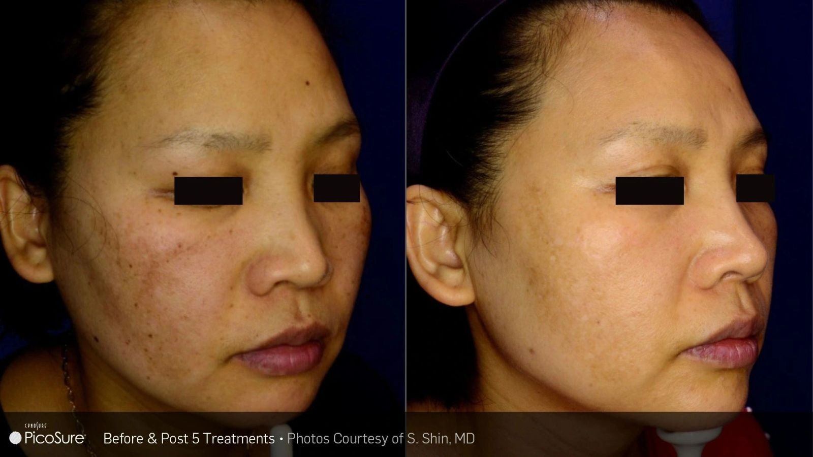 Before and after PicoSure laser treatment showing clearer, more even skin