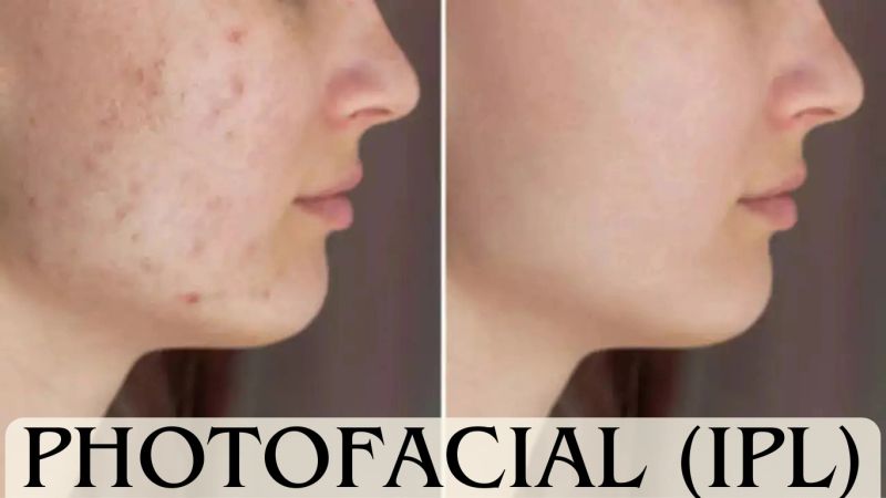 Photofacial, IPL, laser skincare, cosmetic treatments