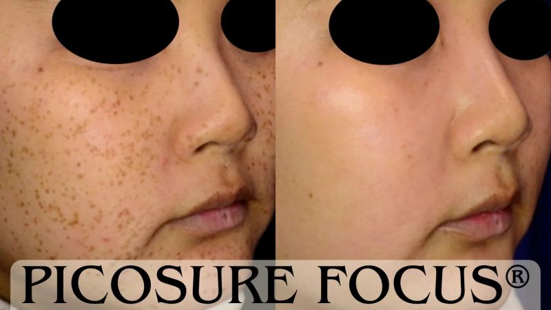 PicoSure, laser skincare, cosmetic treatments